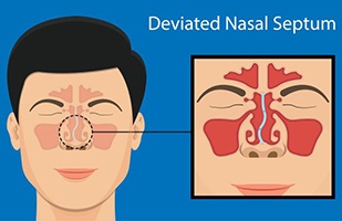 Illustration showing a deviated nasal septum