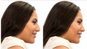 Your specialist for rhinoplasty in Chicago.