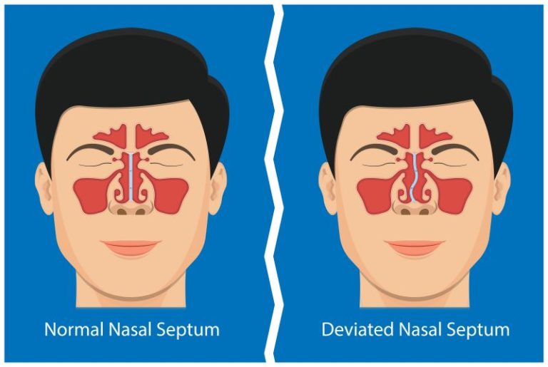 What Causes a Deviated Septum?